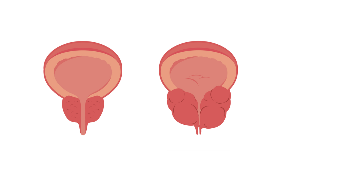 ilustrace zdravé a zbytnělé prostaty