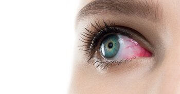 Vitamín D jako součást léčby syndromu suchého oka